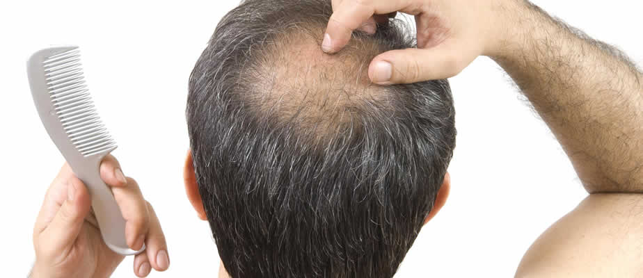 ریزش مو در مردان و درمان ریزش مو